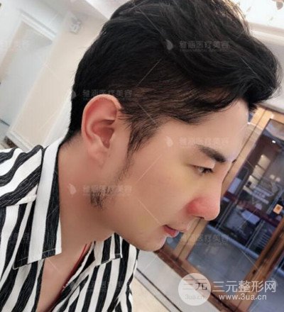 肋軟骨隆鼻整形案例分享，在深圳雅涵做的!