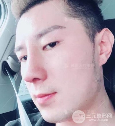 肋軟骨隆鼻整形案例分享，在深圳雅涵做的!