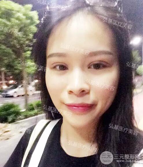 廣州弘基醫(yī)美陳紅利雙眼皮術(shù)后15天果分享