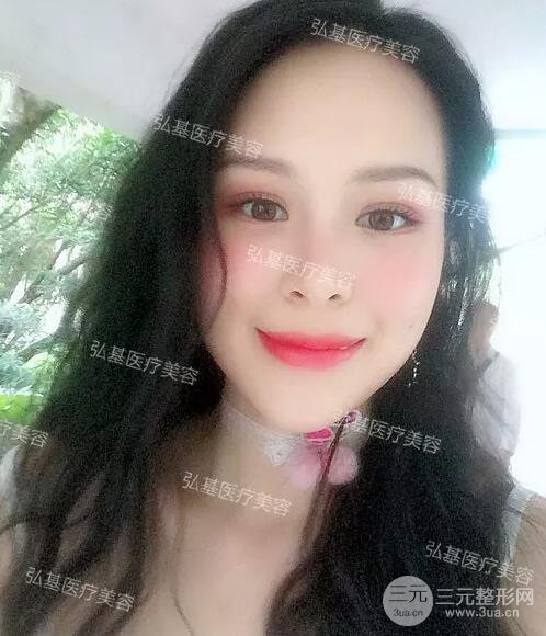 廣州弘基醫(yī)美陳紅利雙眼皮術(shù)后15天果分享