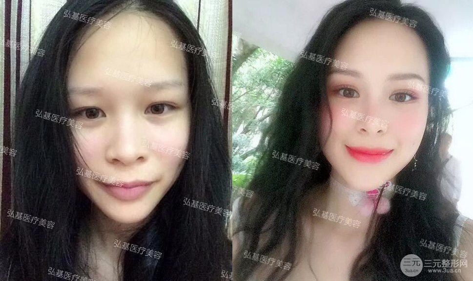 廣州弘基醫(yī)美陳紅利雙眼皮術(shù)后15天果分享