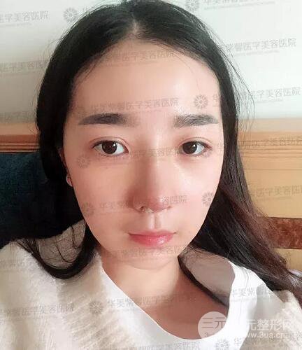 四川成都華美艾玉峰隆鼻修復(fù)案例術(shù)后恢復(fù)圖