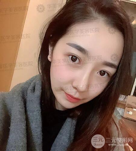 四川成都華美艾玉峰隆鼻修復(fù)案例術(shù)后恢復(fù)圖