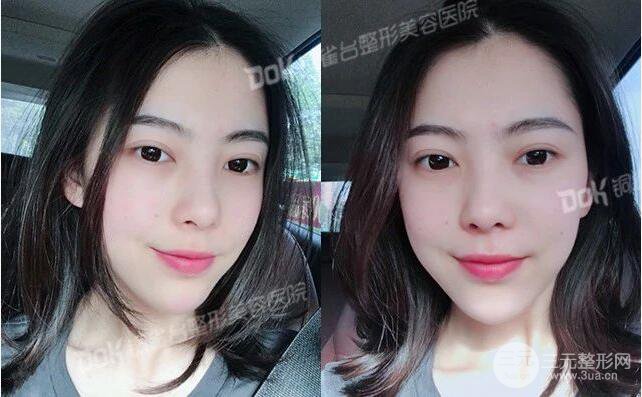 重慶銅雀臺(tái)玻尿酸注射填充案例圖片