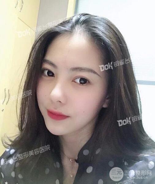 重慶銅雀臺(tái)玻尿酸注射填充案例圖片