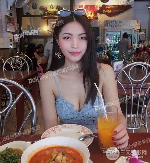 重慶銅雀臺(tái)假體隆胸案例恢復(fù)果圖