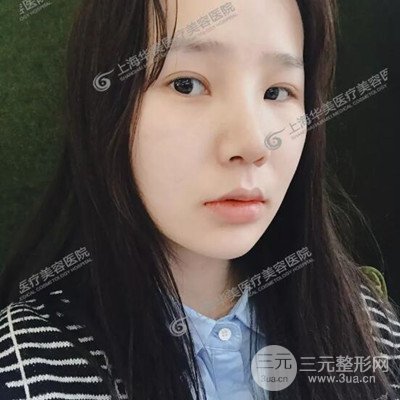 上海華美李志海隆鼻整形案例前后對比圖分享~