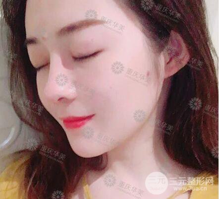 重慶華美何春濤假體隆鼻案例過程恢復(fù)分享