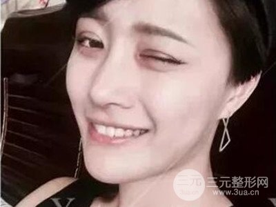 成都藝星切開雙眼皮+隆鼻整形日記分享