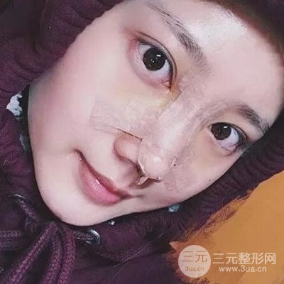 硅膠假體隆鼻案例前后對(duì)比圖分享！顏值變化驚人！