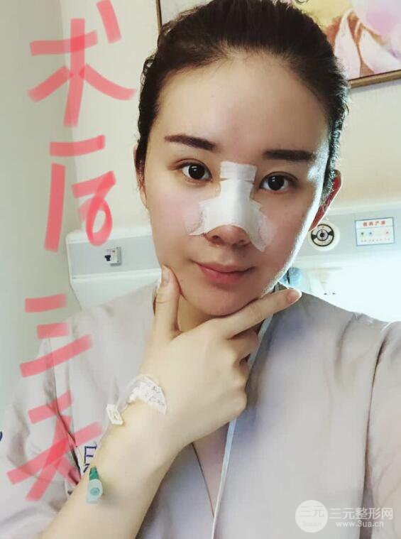 上海華美李庭勛假體隆鼻前后對比圖一個月恢復(fù)心情日記
