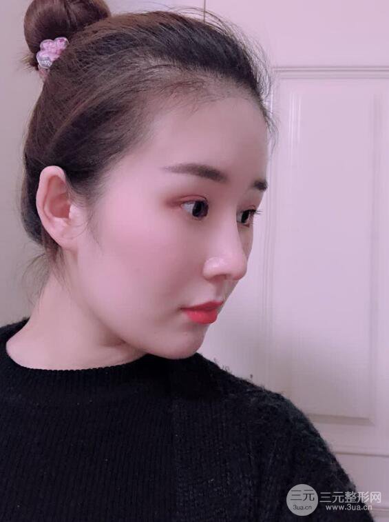 上海華美李庭勛假體隆鼻前后對比圖一個月恢復(fù)心情日記