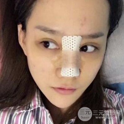 廣州韓妃李光琴隆鼻失敗修復(fù)前后對比圖分享！