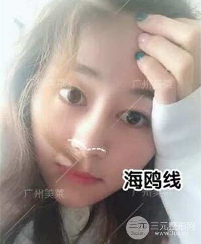 廣州美萊自體軟骨隆鼻案例前后對比圖分享!