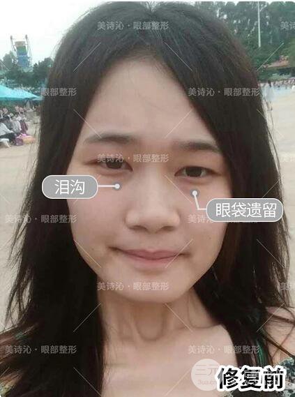 北京詩美沁祛眼袋案例術(shù)后果分享！