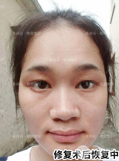 北京詩美沁祛眼袋案例術(shù)后果分享！