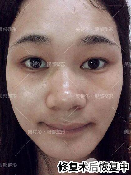 北京詩美沁祛眼袋案例術(shù)后果分享！