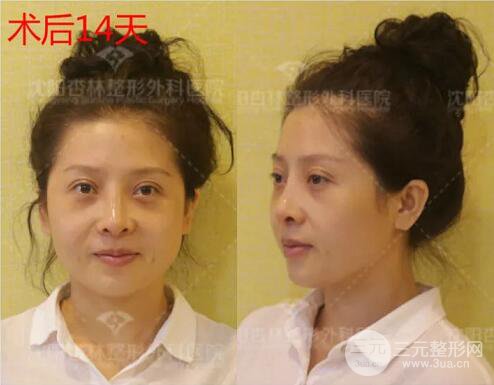 沈陽杏林朱石江隆鼻隆鼻整形案例手術過程記錄