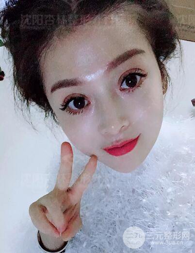 沈陽杏林朱石江隆鼻隆鼻整形案例手術過程記錄