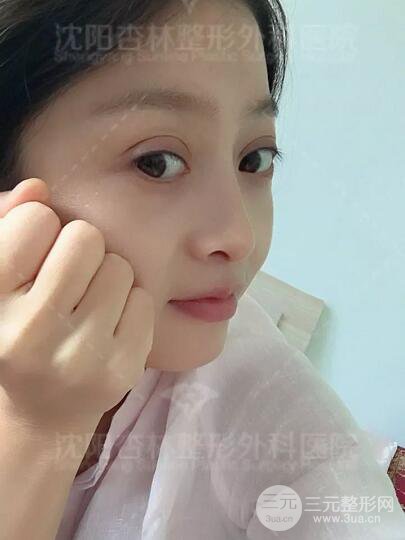 沈陽杏林朱石江隆鼻隆鼻整形案例手術過程記錄