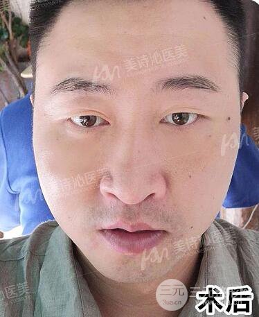 北京詩美沁祛眼袋案例，男士微創(chuàng)祛眼袋果分享！