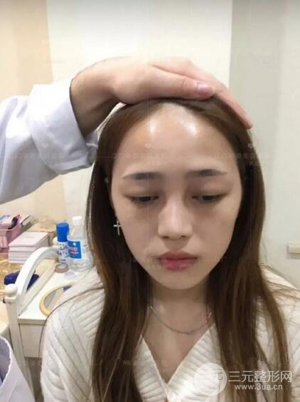 重慶愛思特整形隆鼻案例術(shù)后恢復(fù)果分享！