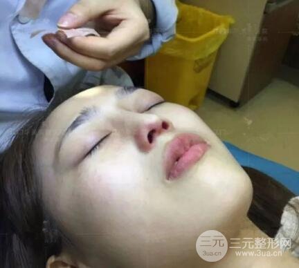 重慶愛思特整形隆鼻案例術(shù)后恢復(fù)果分享！