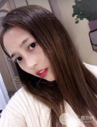 重慶愛思特整形隆鼻案例術(shù)后恢復(fù)果分享！