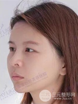 沈陽美萊高國林自體脂肪填充面部案例前后對比果圖分享