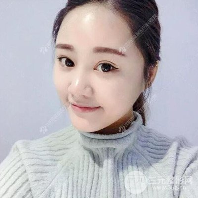 沈陽(yáng)百嘉麗汪曉蕾自體脂肪面部填充恢復(fù)記錄案例分享~