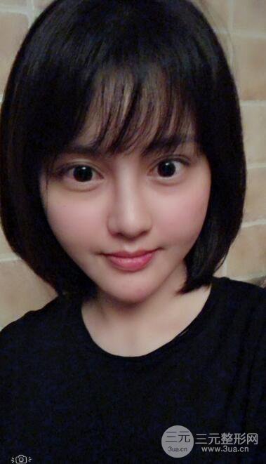 常州施爾美廉鋒自體脂肪豐臉對(duì)照?qǐng)D案例心情日扎