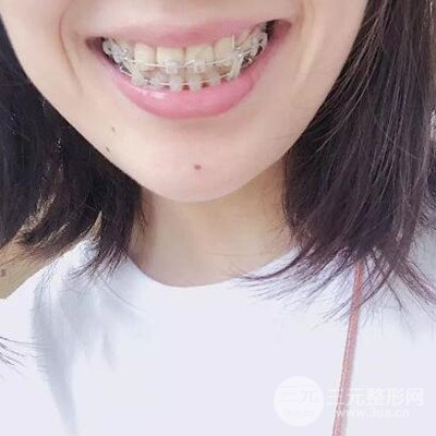 成都格林口腔唐建忠牙齒矯正案例前后對(duì)比圖分享~