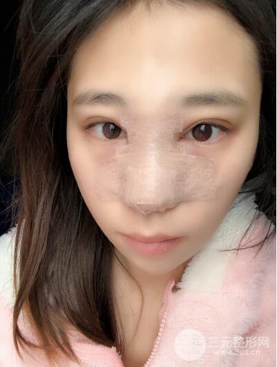貴陽麗都李觀龍隆鼻整形案例對(duì)照?qǐng)D一個(gè)月恢復(fù)過程分享