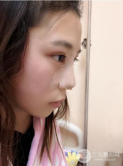 貴陽麗都李觀龍隆鼻整形案例對(duì)照?qǐng)D一個(gè)月恢復(fù)過程分享