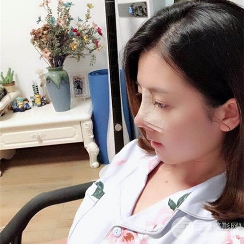 重慶五洲范文亮自體肋軟骨隆鼻案例前后對(duì)比圖分享~