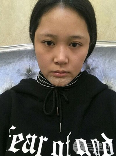 四川友誼李萍醫(yī)生假體墊下巴前后對(duì)比果圖片分享~