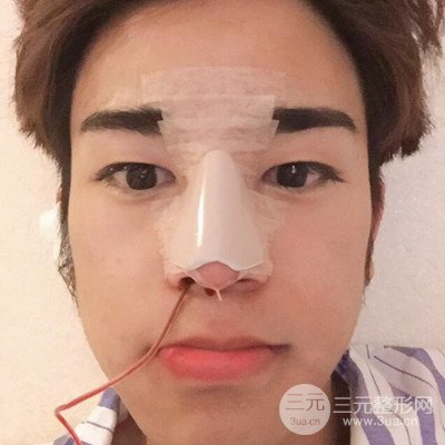 成都蜀尚蓉雅陳建華隆鼻整形前后對(duì)比照分享~