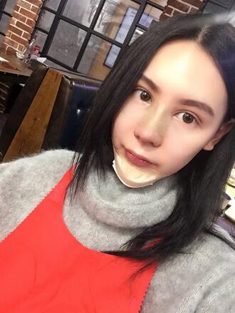 成都天使之翼做隆鼻整形改變了我的塌鼻子 果真的很不錯