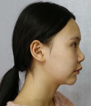 成都天使之翼做隆鼻整形改變了我的塌鼻子 果真的很不錯