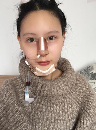 成都天使之翼做隆鼻整形改變了我的塌鼻子 果真的很不錯