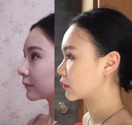 成都天使之翼做隆鼻整形改變了我的塌鼻子 果真的很不錯