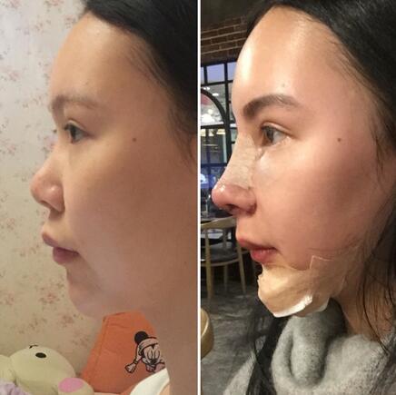 成都天使之翼做隆鼻整形改變了我的塌鼻子 果真的很不錯