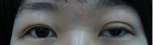 雙眼皮修復(fù)需要慎重 可是我幸運(yùn)的修復(fù)好了雙眼皮