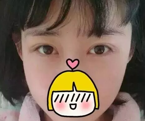 雙眼皮修復(fù)需要慎重 可是我幸運(yùn)的修復(fù)好了雙眼皮