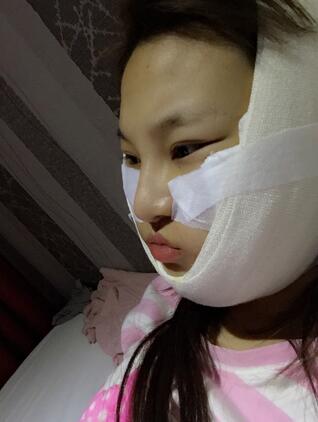 終于做了顴骨內(nèi)推了還是在北京八大處果我放心