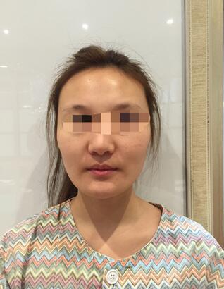 終于做了顴骨內(nèi)推了還是在北京八大處果我放心