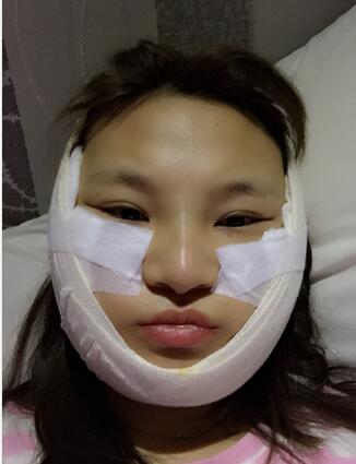 終于做了顴骨內(nèi)推了還是在北京八大處果我放心