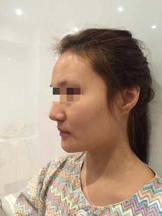 終于做了顴骨內(nèi)推了還是在北京八大處果我放心