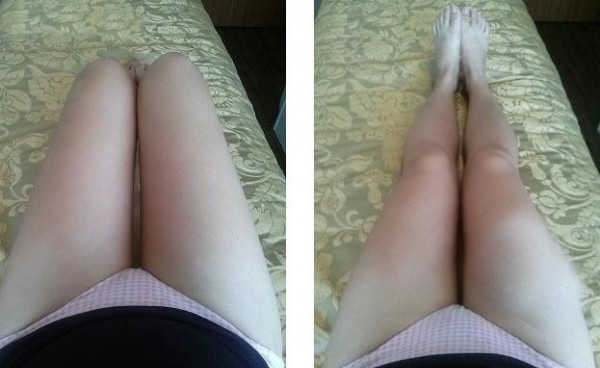 大腿吸脂三個月 瘦了很多