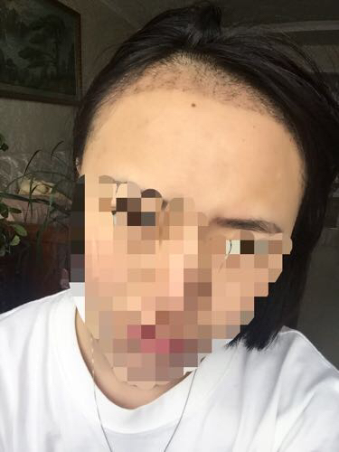 成都玉之光頭發(fā)移植 果杠杠的~